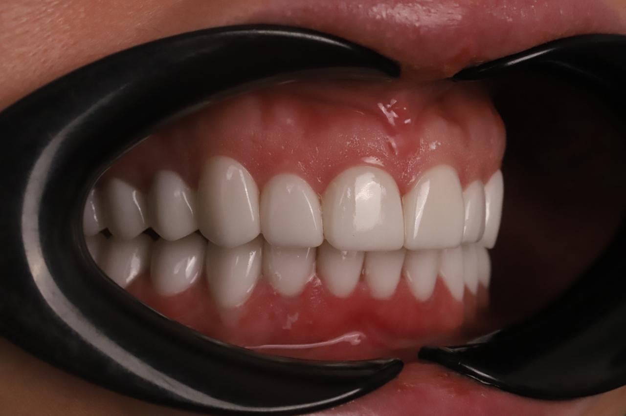 Циркониевые коронки