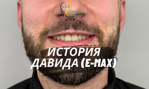 История Давида (E-Max)