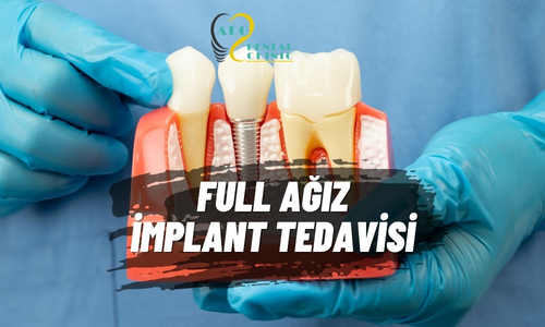 24 Saatte Full İmplant