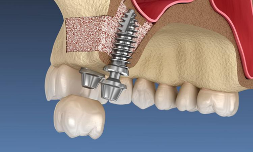 Костная пластика и синус-лифтинг