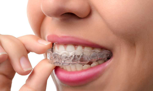 Прозрачные каппы (Invisalign)