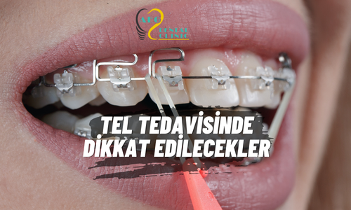 Tel Tedavisinde Dikkat Edilmesi Gerekenler Nelerdir?